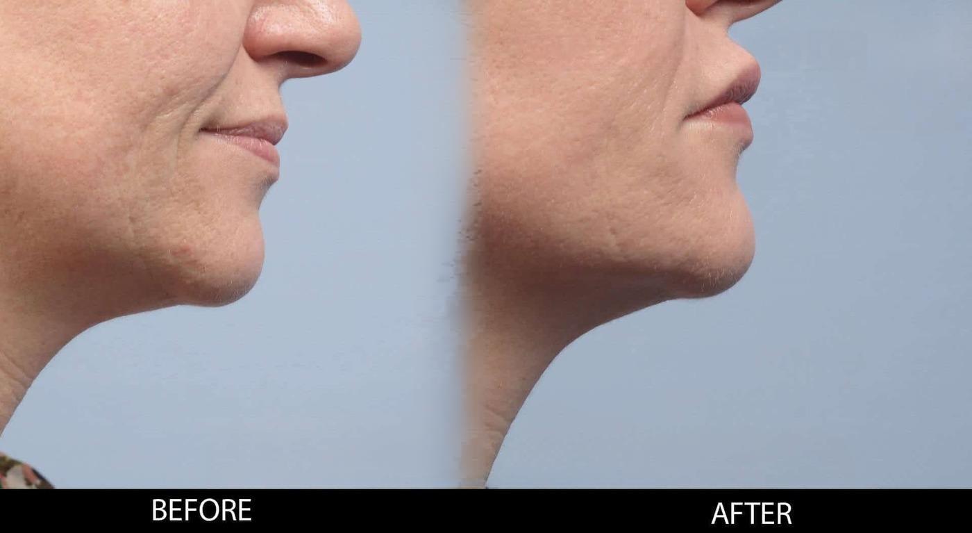 Soft Tissue Fillers - Patient Before and After Gallery – Photo 29
