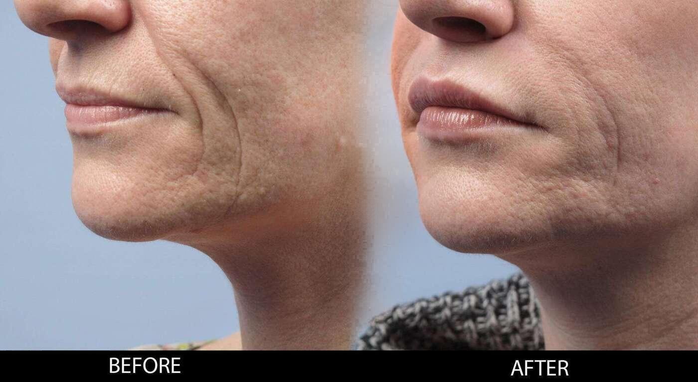 Soft Tissue Fillers - Patient Before and After Gallery – Photo 7