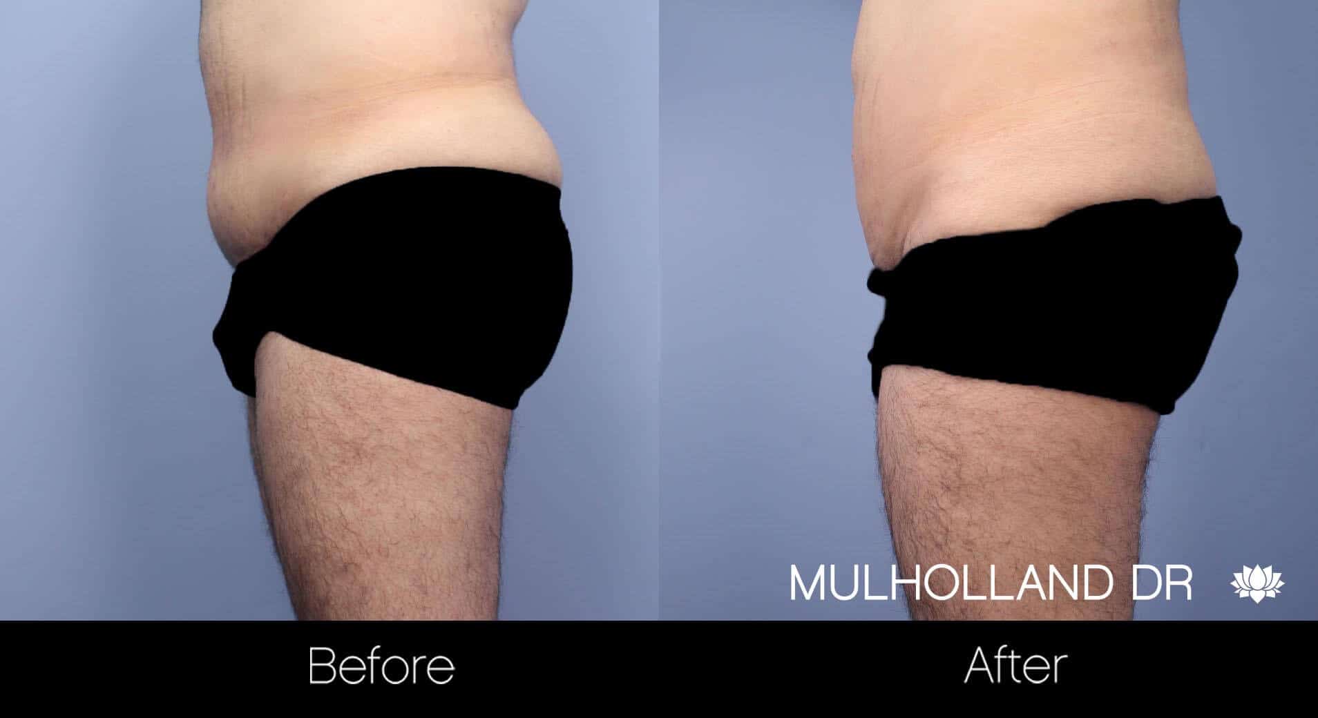 Male Tummy Tuck (Belt Lipectomy) - Before and After Gallery – Photo 10