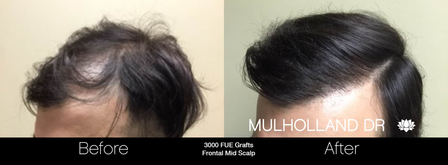 FUE Hair Male - Before and After Gallery – Photo 10