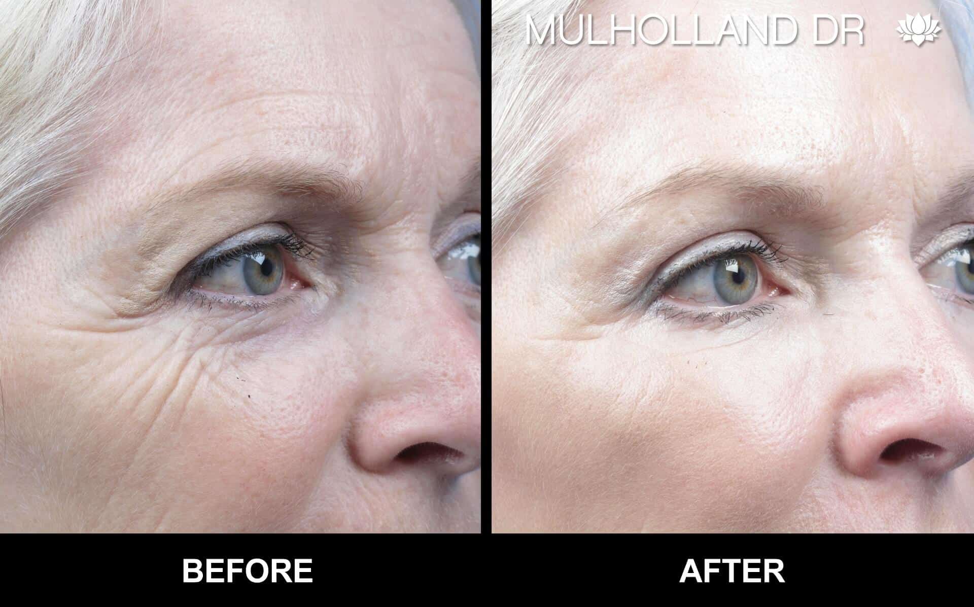 Fractora - Before and After Gallery – Photo 9