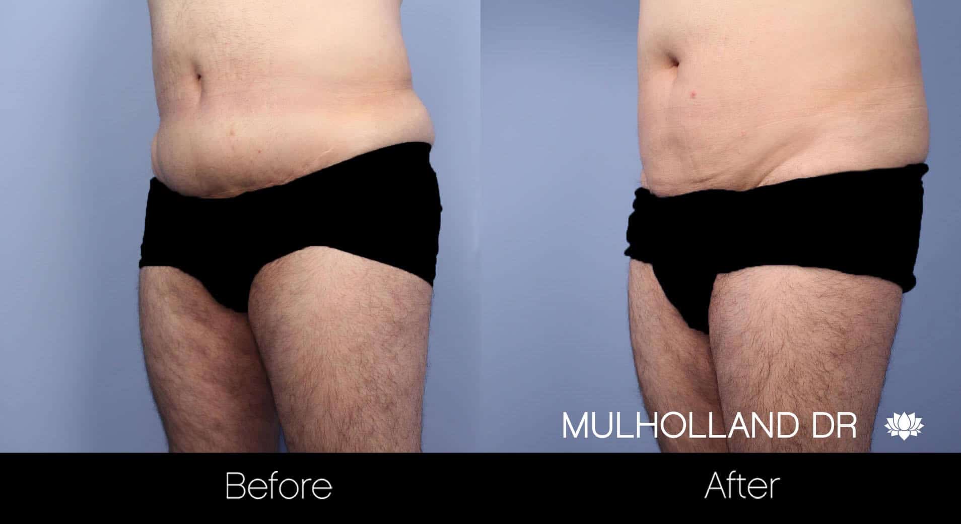 Male Tummy Tuck (Belt Lipectomy) - Before and After Gallery – Photo 11