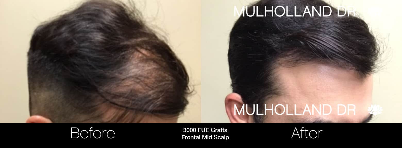 FUE Hair Male - Before and After Gallery – Photo 11