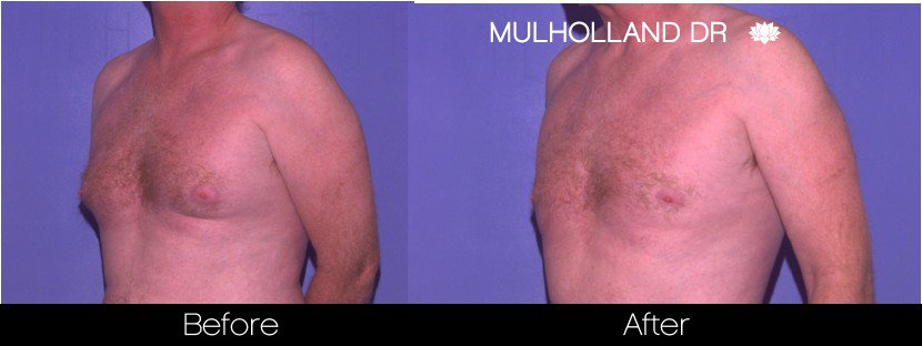 Gynecomastia Surgery (Male Breast Reduction) - Before and After Gallery – Photo 4