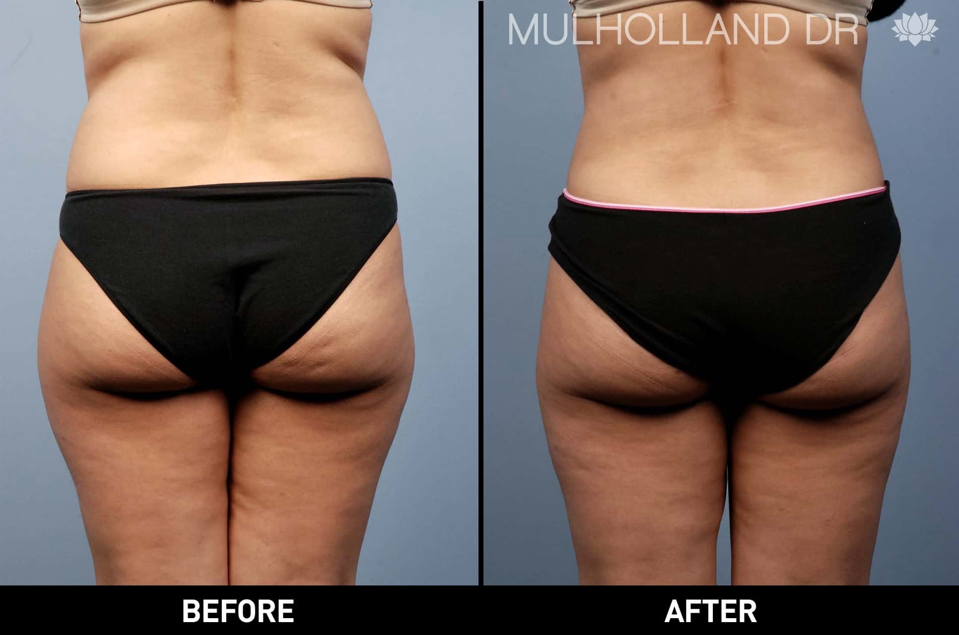 BodyTite Liposuction - Before and After Gallery – Photo 13