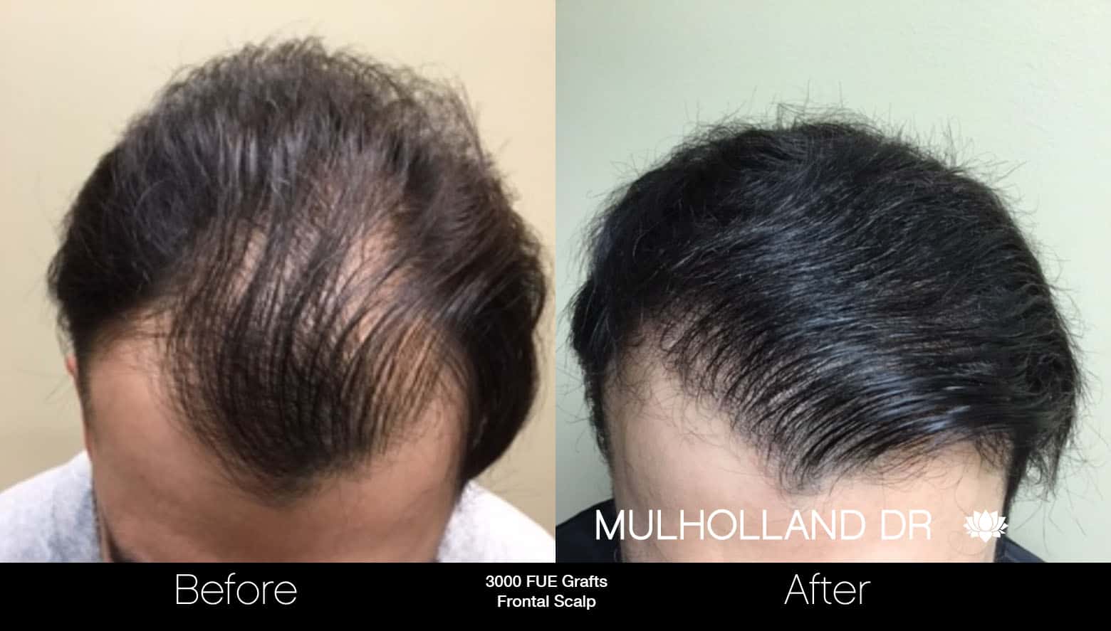 FUE Hair Male - Before and After Gallery – Photo 12
