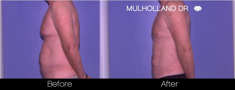 Gynecomastia Surgery (Male Breast Reduction) - Before and After Gallery – Photo 5