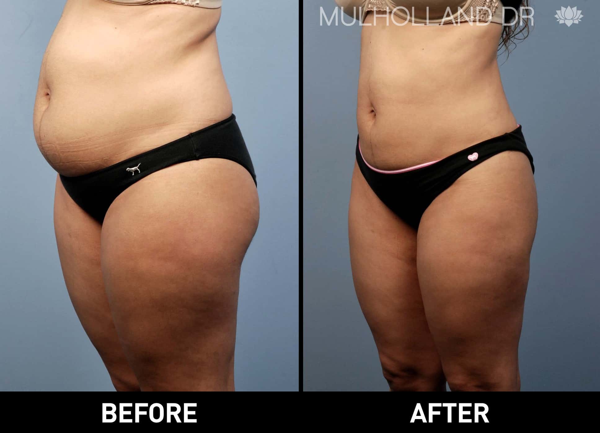 Tumescent Liposuction - Before and After Gallery – Photo 3