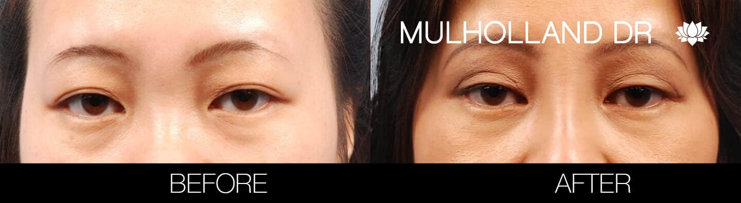 Asian Blepharoplasty - Before and After Gallery – Photo 8