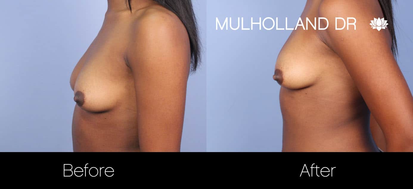 Fat Grafting Breast Augmentation - Before and After Gallery – Photo 13