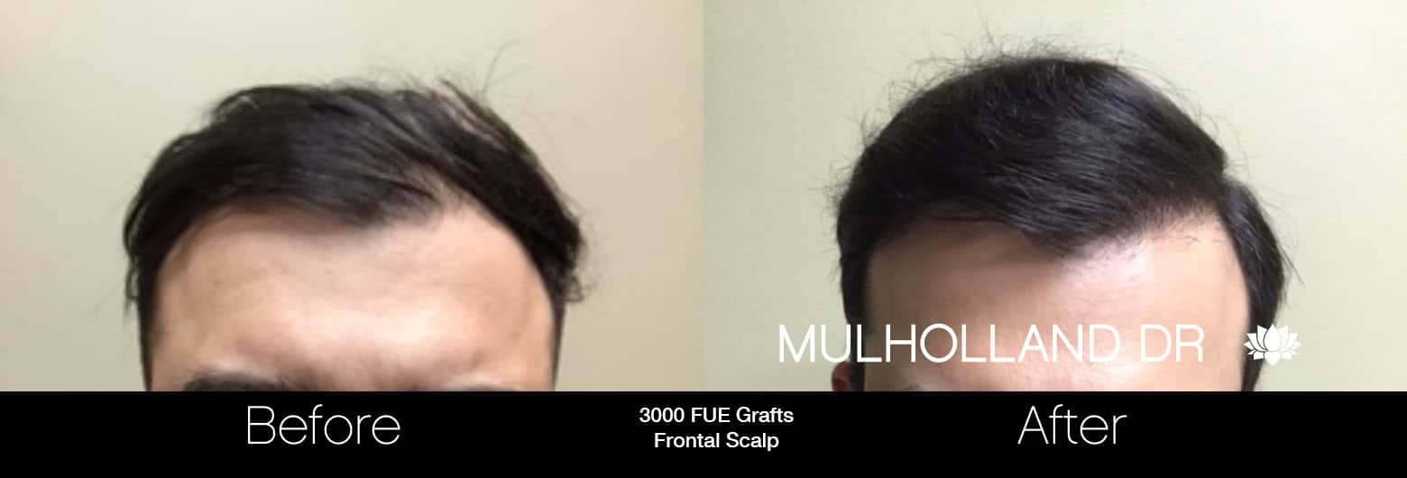 FUE Hair Male - Before and After Gallery – Photo 13