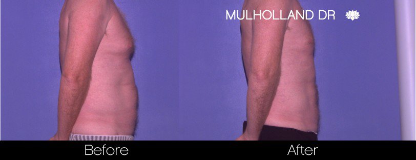 Gynecomastia Surgery (Male Breast Reduction) - Before and After Gallery – Photo 6