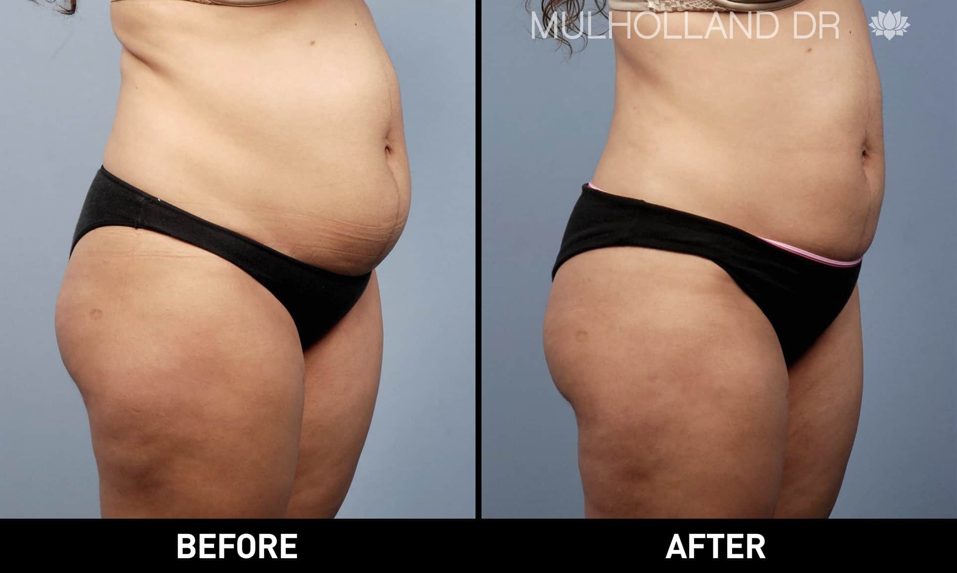 Tumescent Liposuction - Before and After Gallery – Photo 4
