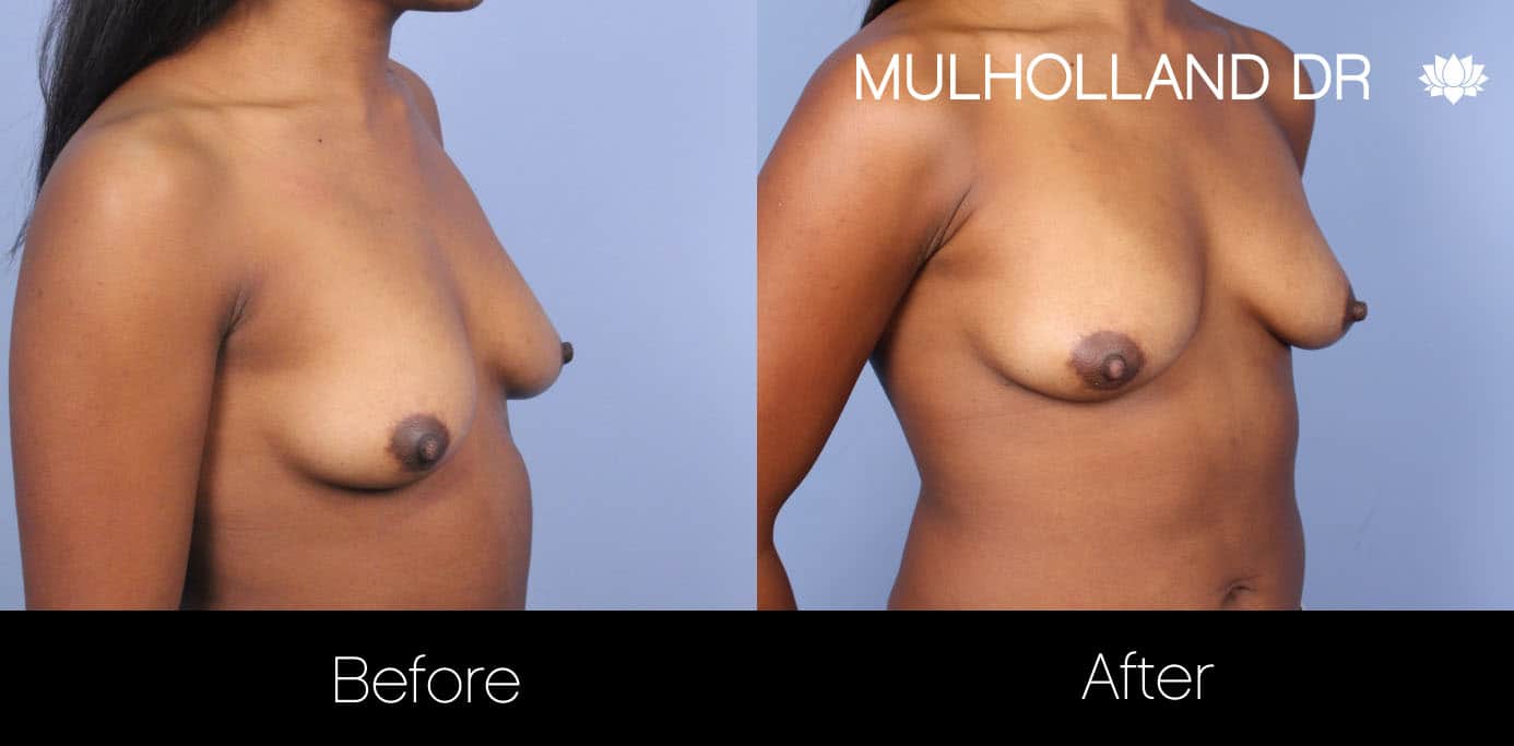 Fat Grafting Breast Augmentation - Before and After Gallery – Photo 14