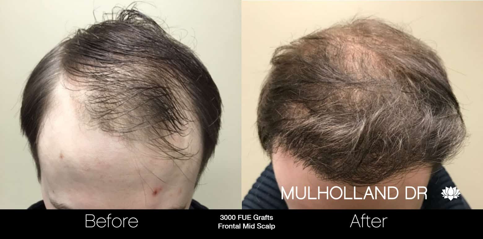 FUE Hair Male - Before and After Gallery – Photo 14