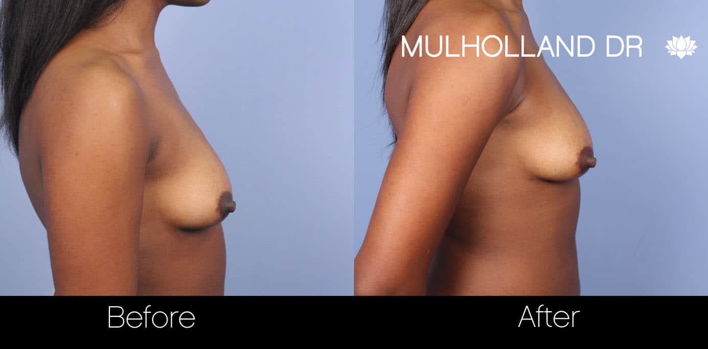 Fat Grafting Breast Augmentation - Before and After Gallery – Photo 15