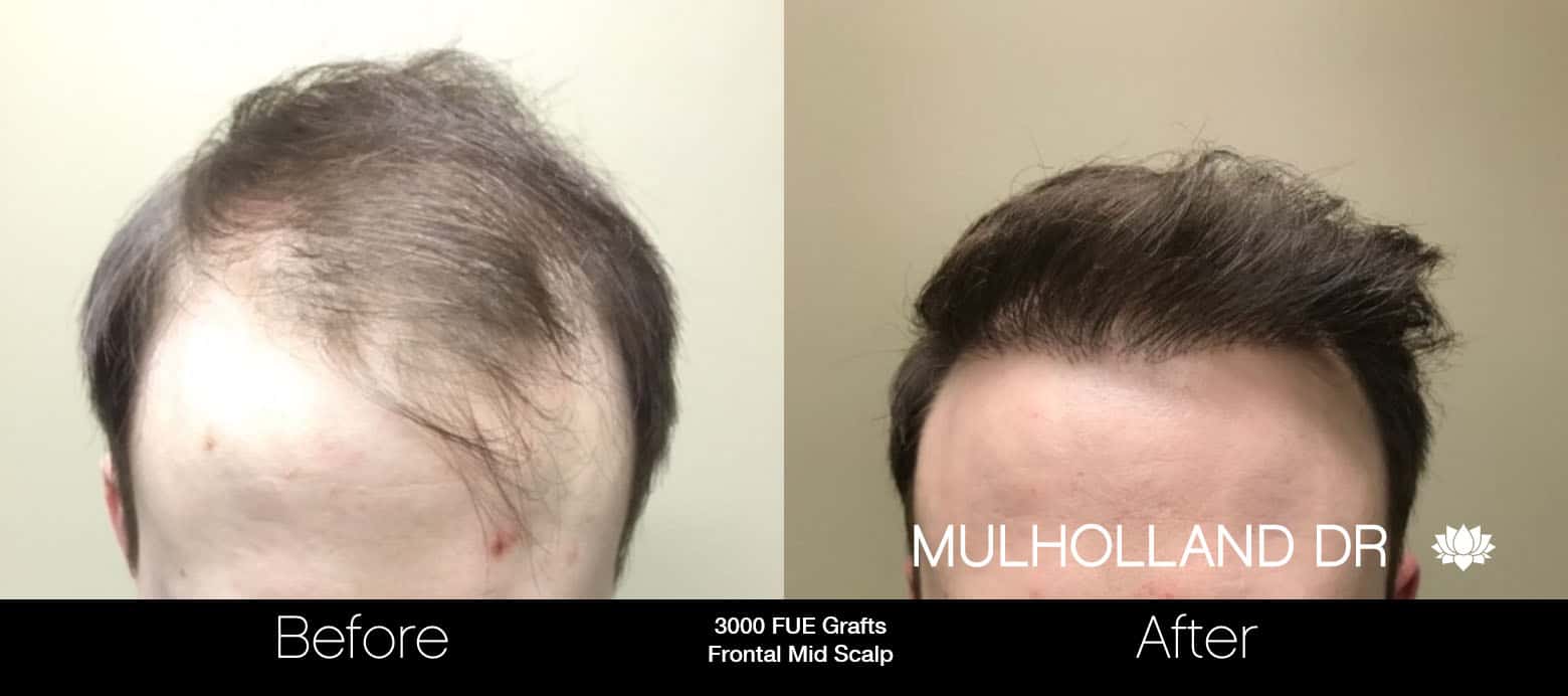FUE Hair Male - Before and After Gallery – Photo 15
