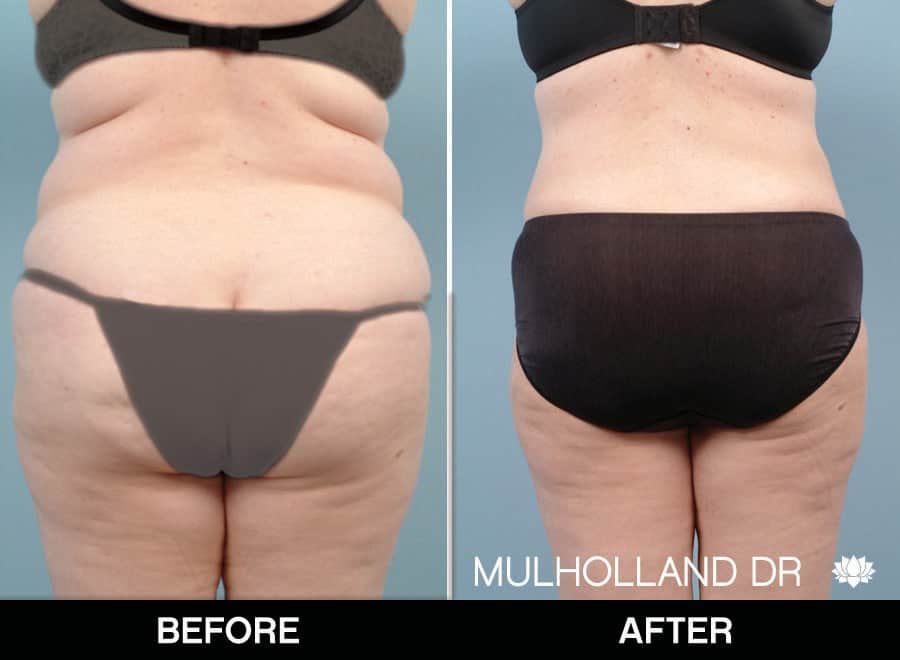 Tumescent Liposuction - Patient 2
