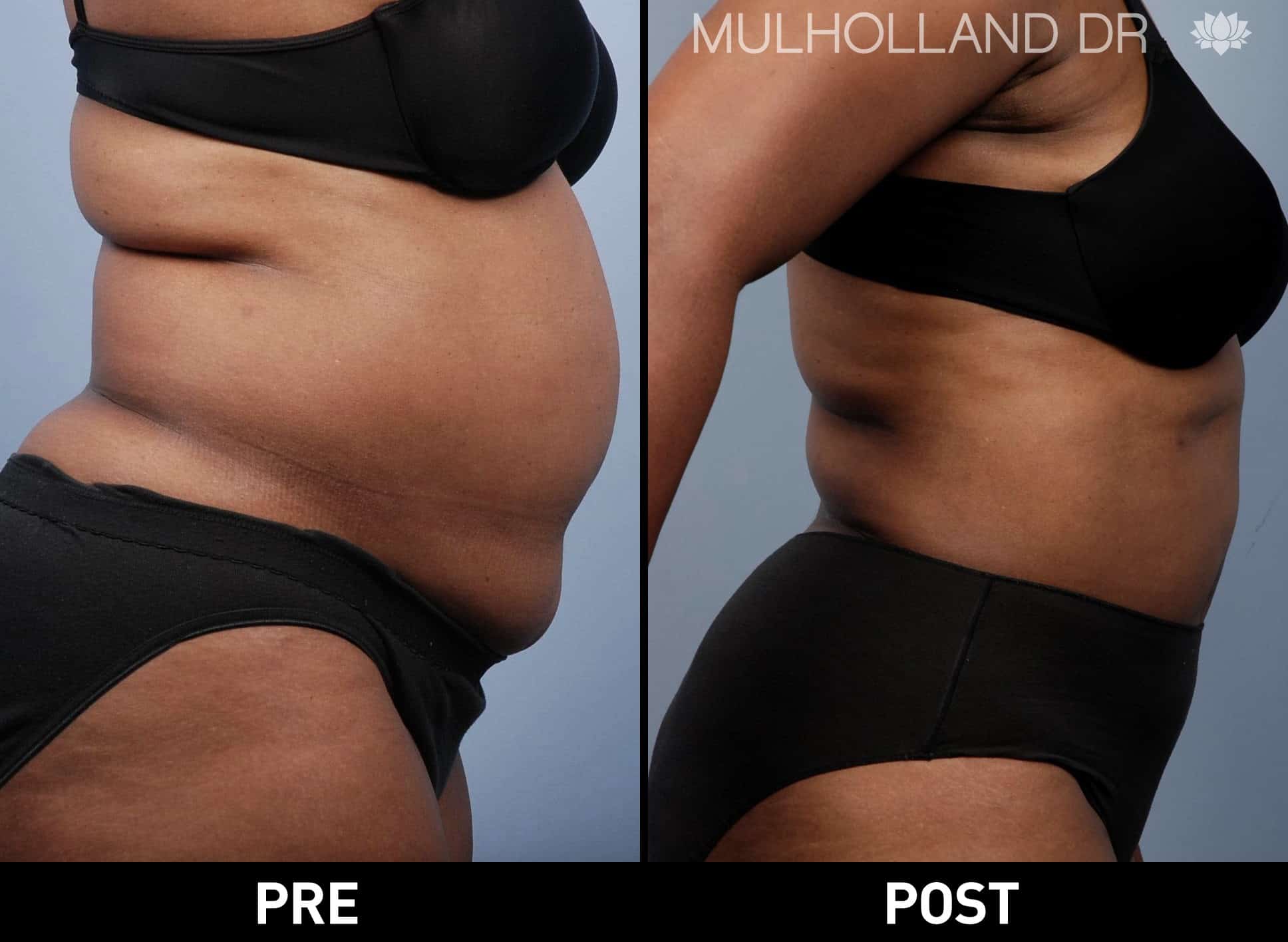 Tumescent Liposuction - Before and After Gallery – Photo 1