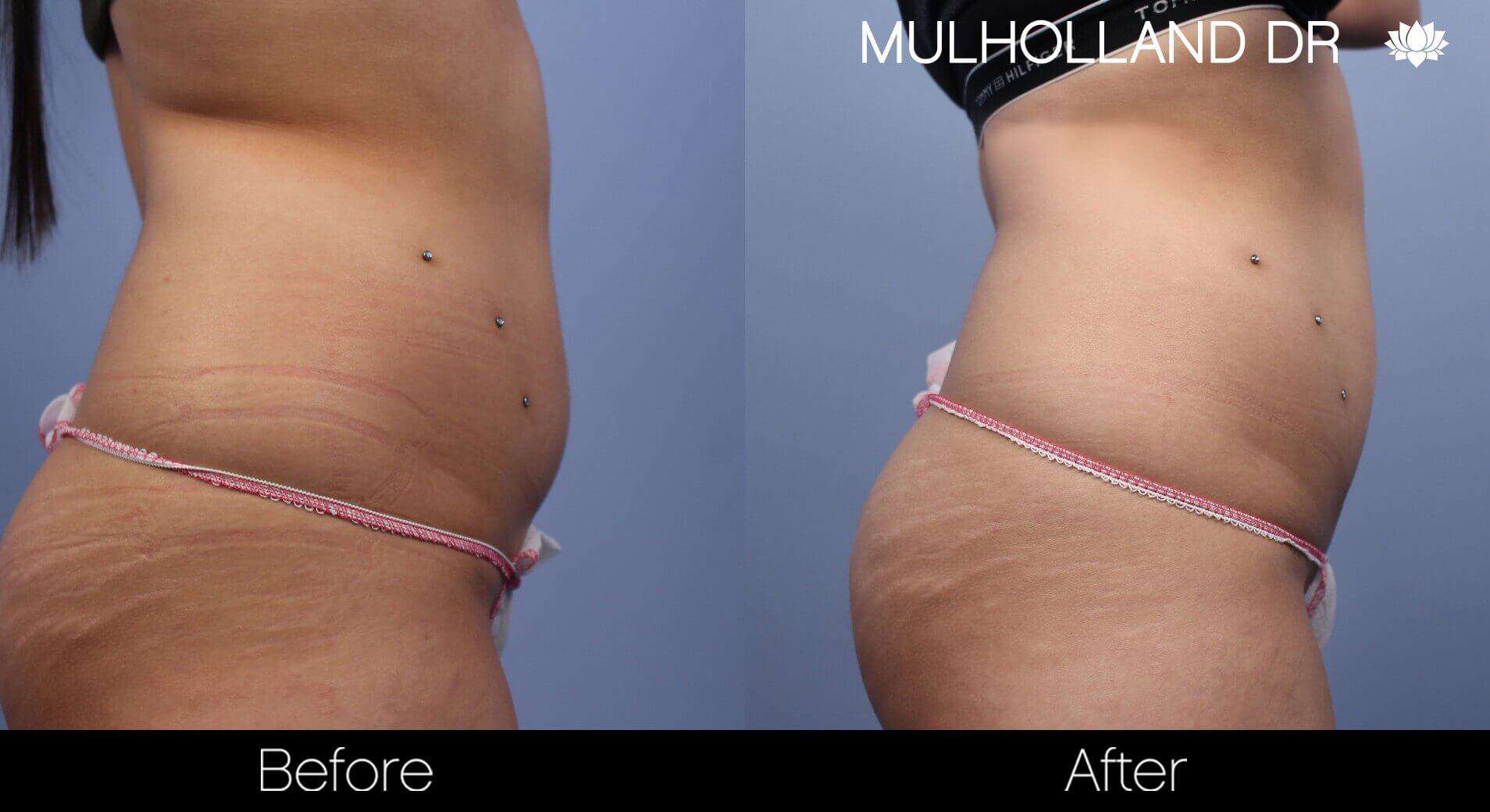 Body Contouring and Reshaping - Before and After Gallery – Photo 1