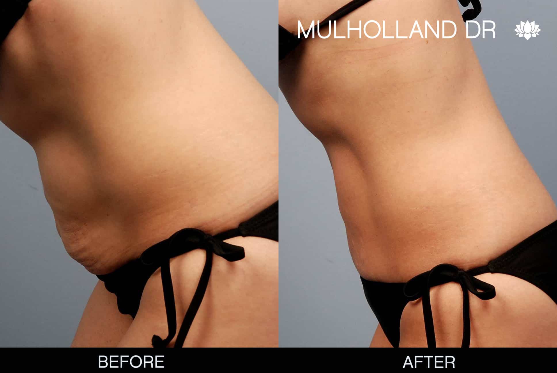 Mini Tummy Tuck - Before and After Gallery – Photo 1