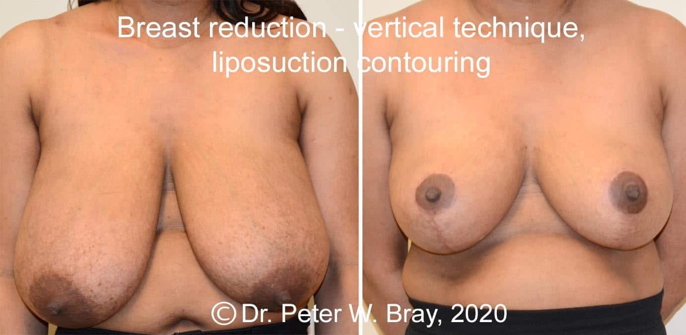 Breast Reduction - Before and After Gallery – Photo 1