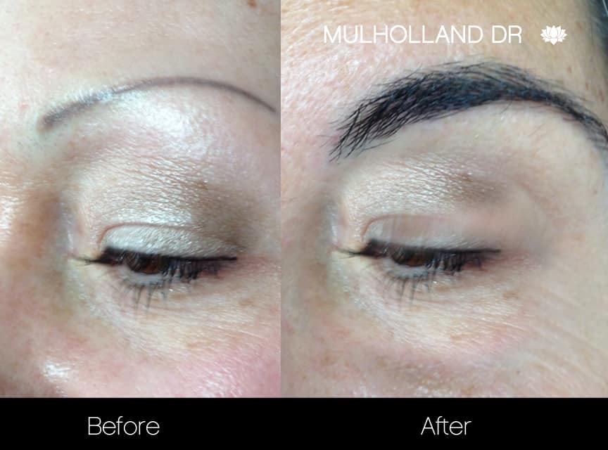 Eyebrows FUE - Before and After Gallery – Photo 1