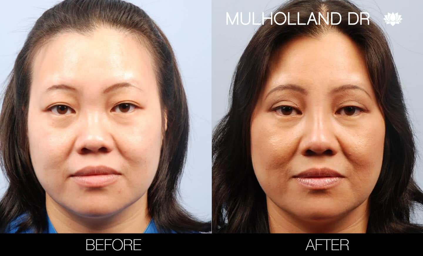 Asian Blepharoplasty - Before and After Gallery – Photo 1
