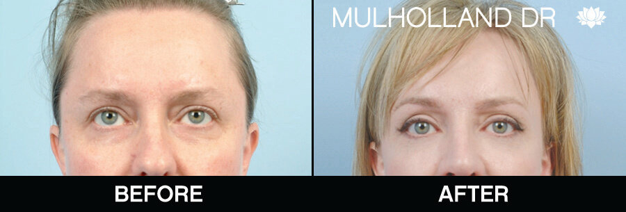 Brow Lift - Before and After Gallery – Photo 1