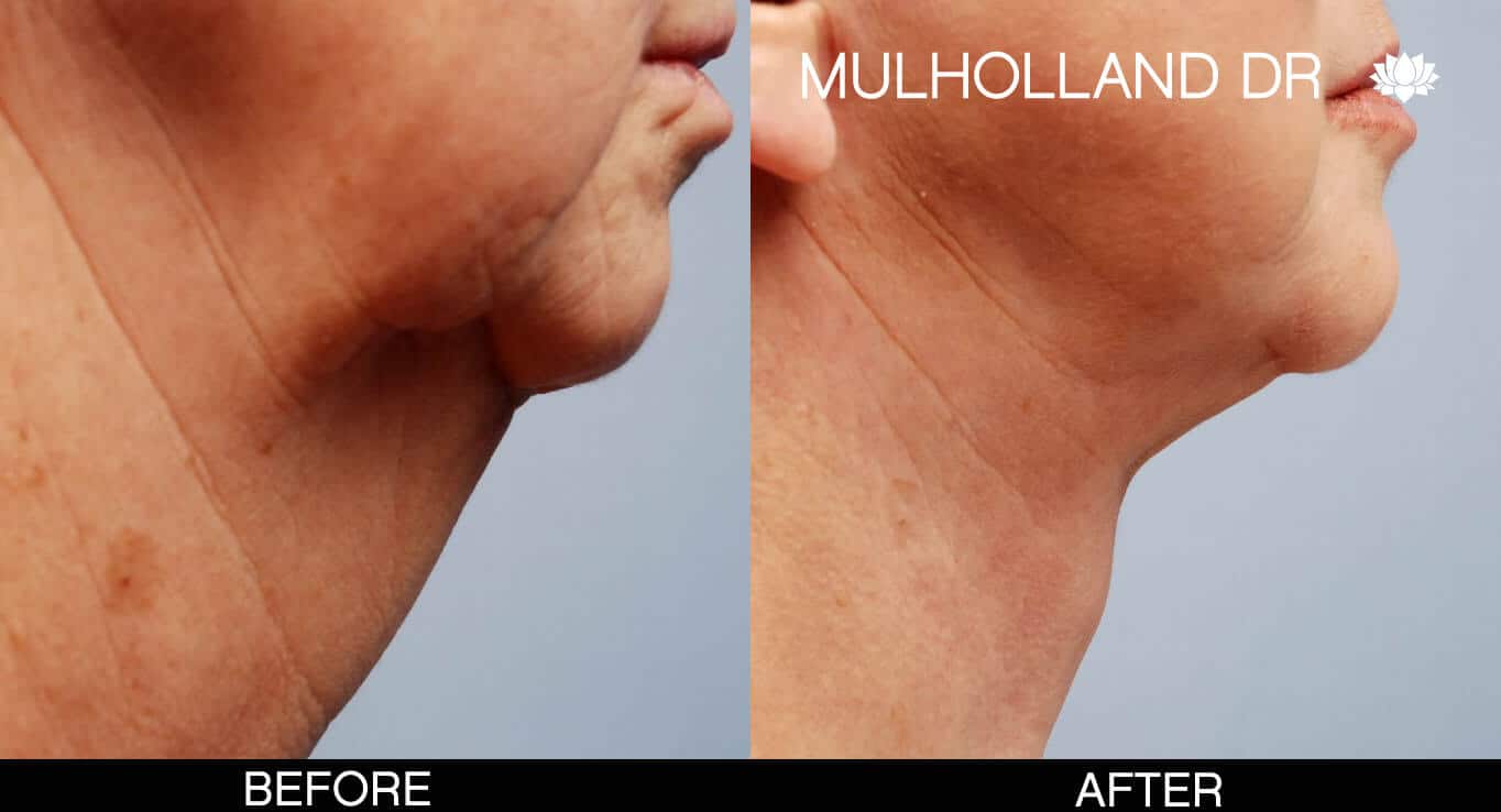 Neck Lift- Before and After Gallery – Photo 1