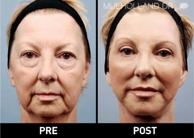 Facial Fat Transfer - Before and After Gallery – Photo 1