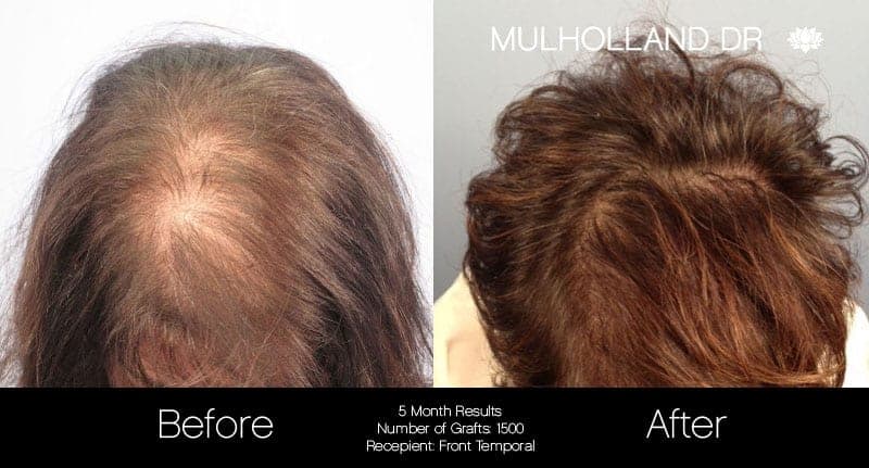 FUE Hair Female - Before and After Gallery – Photo 1