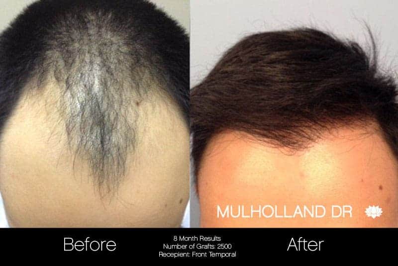 FUE Hair Male - Before and After Gallery – Photo 1