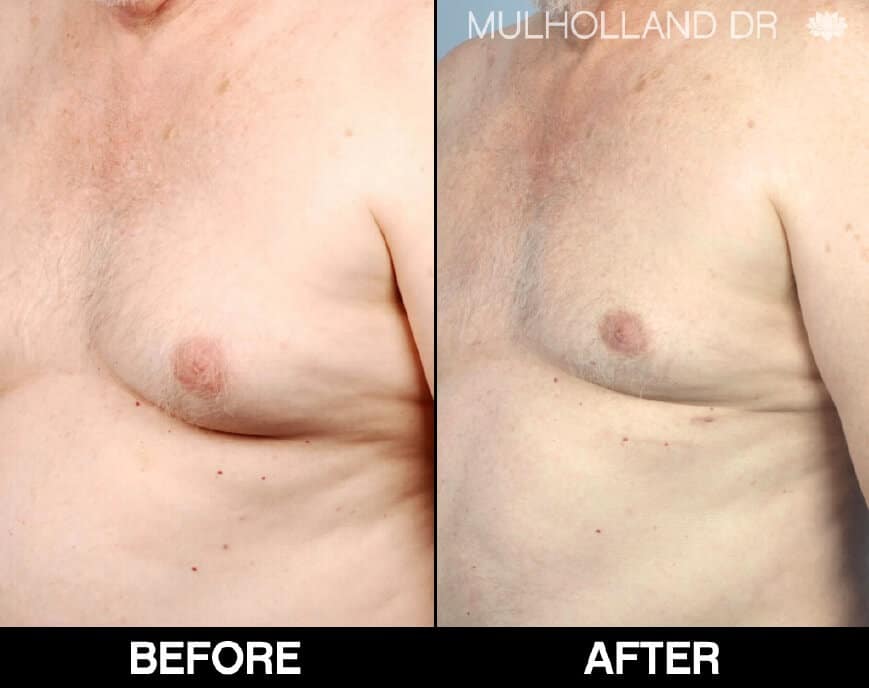 Gynecomastia Surgery (Male Breast Reduction) - Before and After Gallery – Photo 1