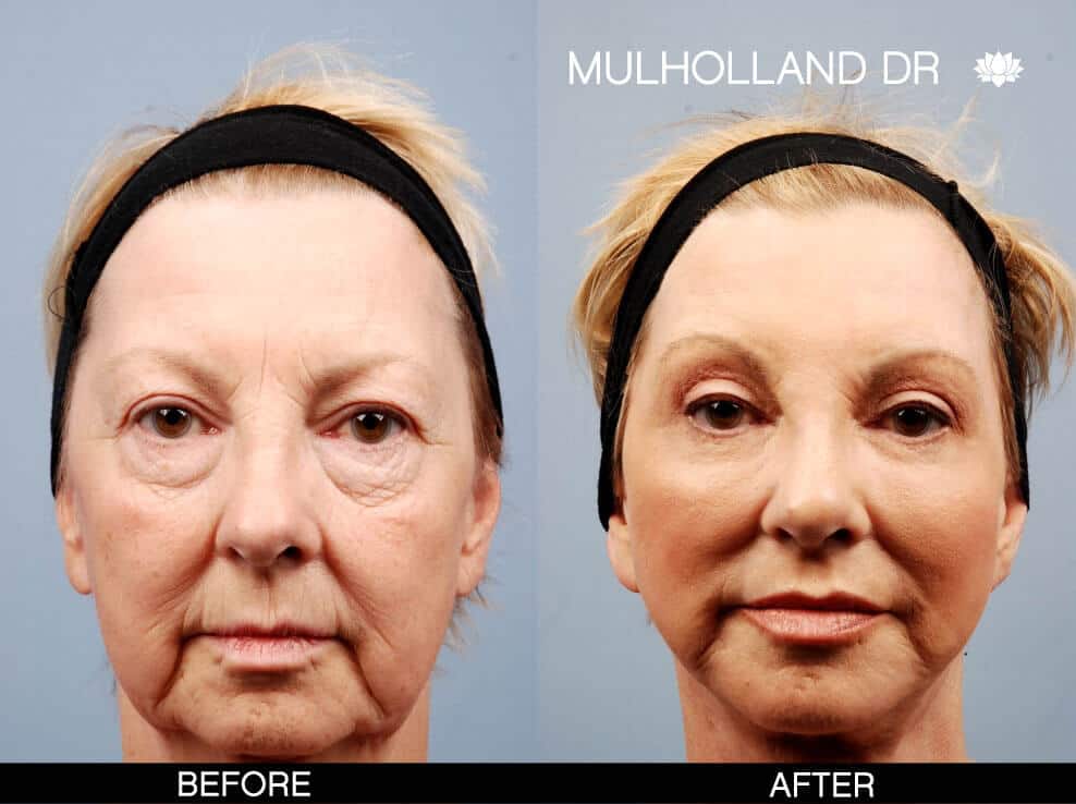 Cheek Lift - Before and After Gallery – Photo 11