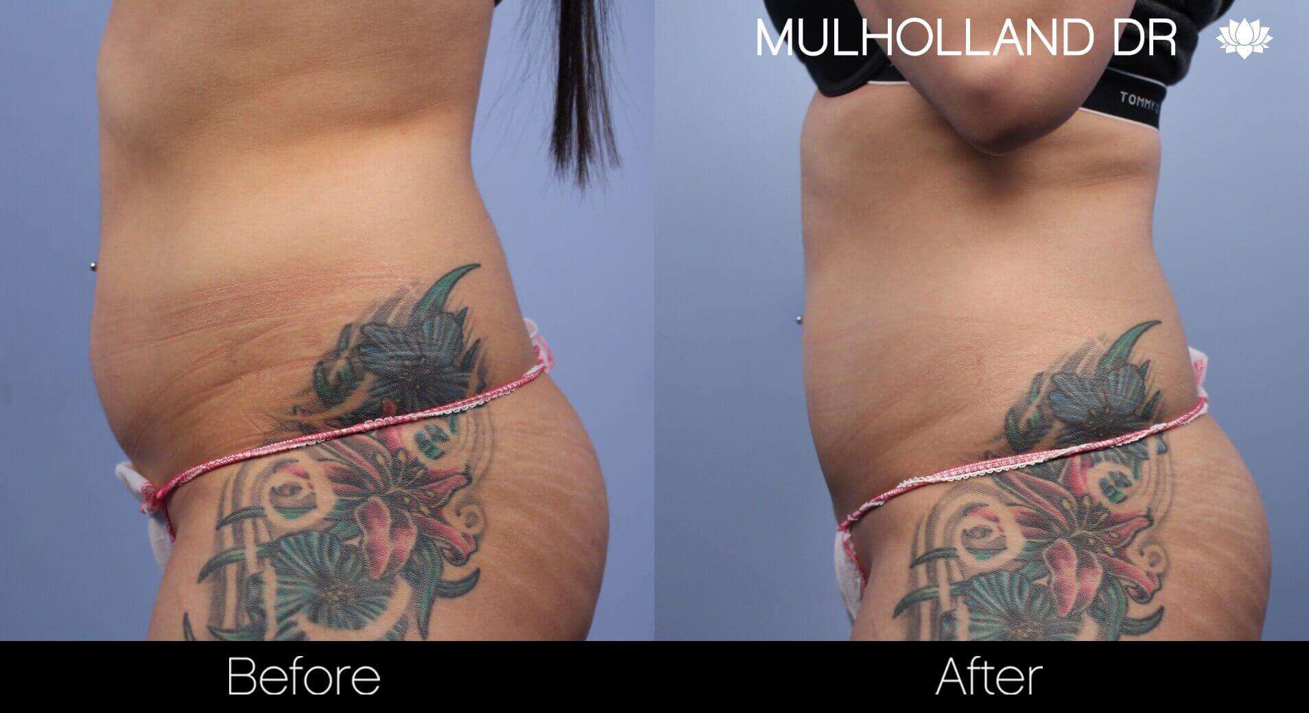 Body Contouring and Reshaping - Before and After Gallery – Photo 2