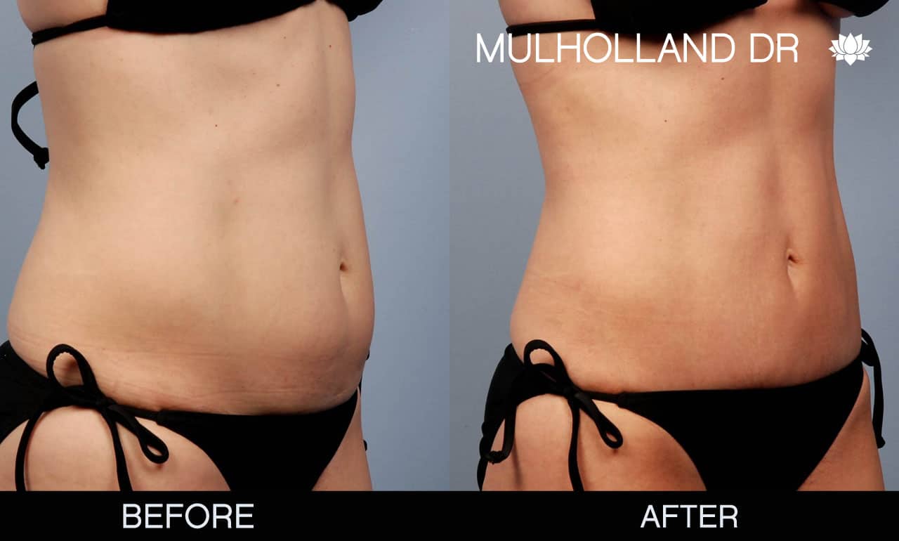 Mini Tummy Tuck - Before and After Gallery – Photo 2