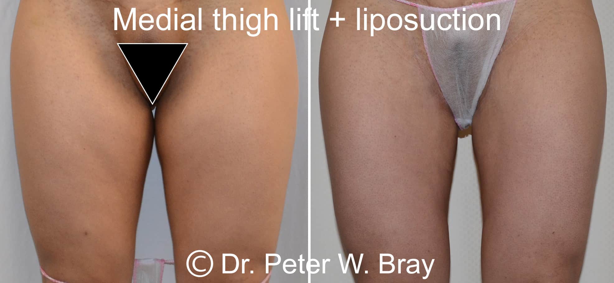 Thigh Lift - Before and After Gallery – Photo 2