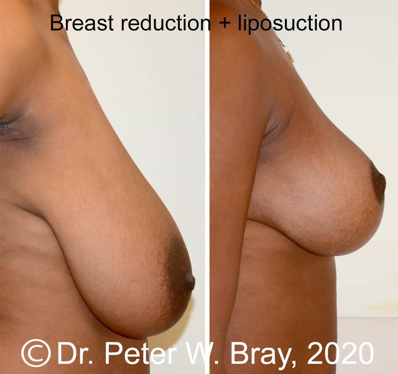 Breast Reduction - Before and After Gallery – Photo 2