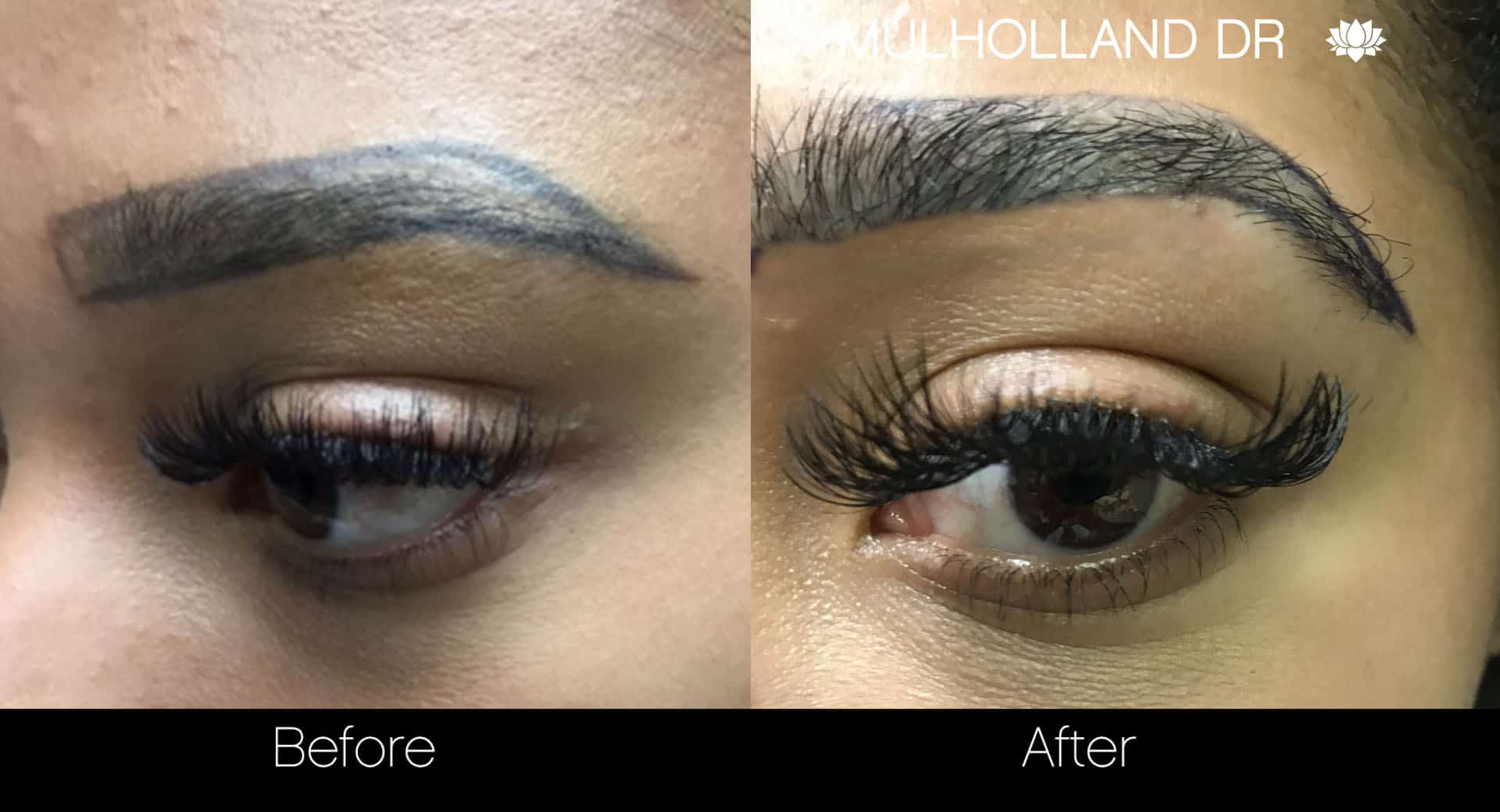 Eyebrows FUE - Before and After Gallery – Photo 2