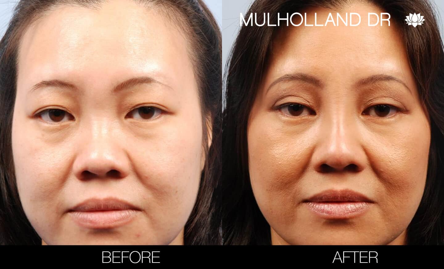 Asian Blepharoplasty - Before and After Gallery – Photo 2