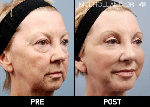 Facial Fat Transfer - Before and After Gallery – Photo 2