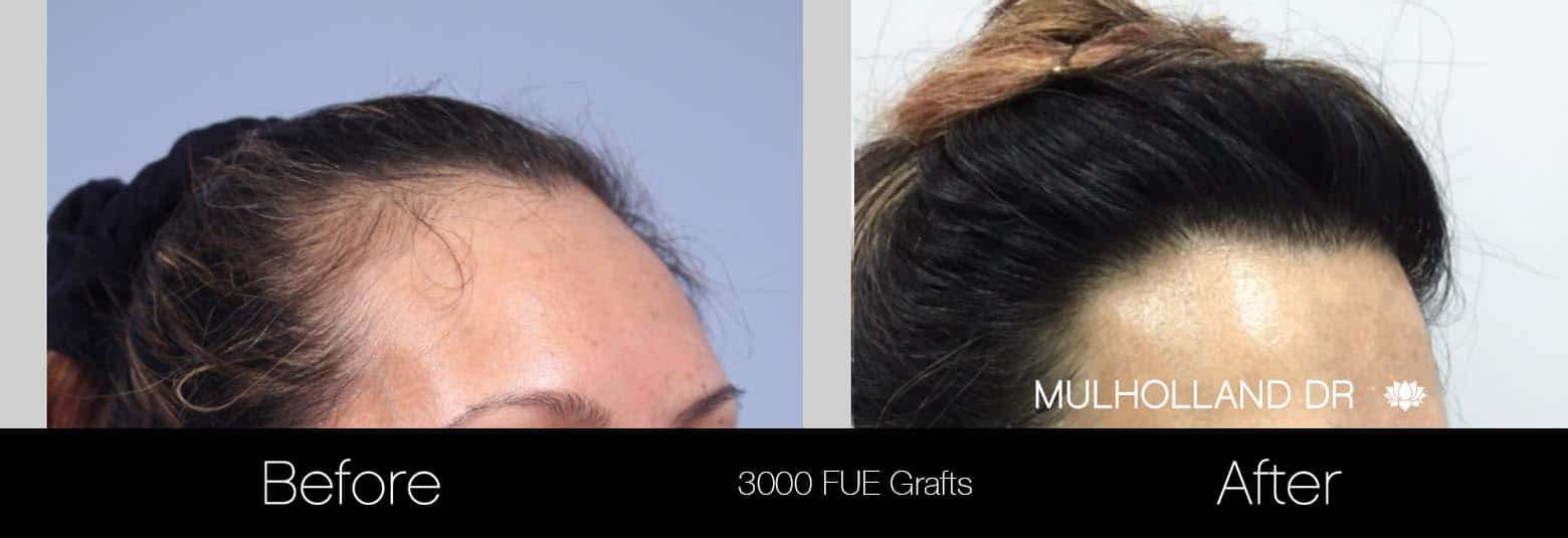 FUE Hair Female - Before and After Gallery – Photo 2