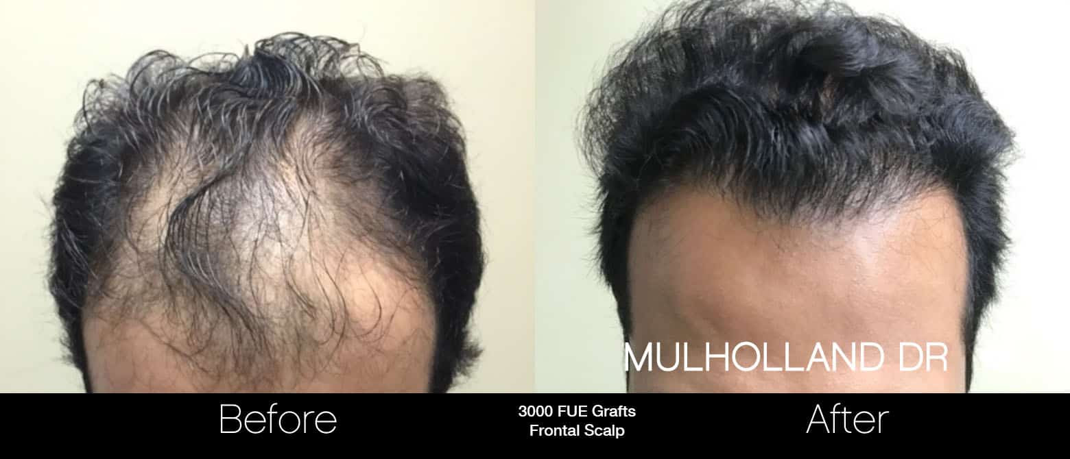 FUE Hair Male - Before and After Gallery – Photo 2