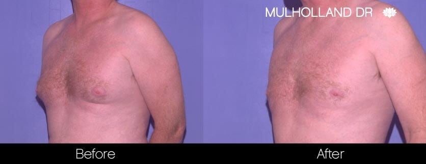 Gynecomastia Surgery (Male Breast Reduction) - Before and After Gallery – Photo 2