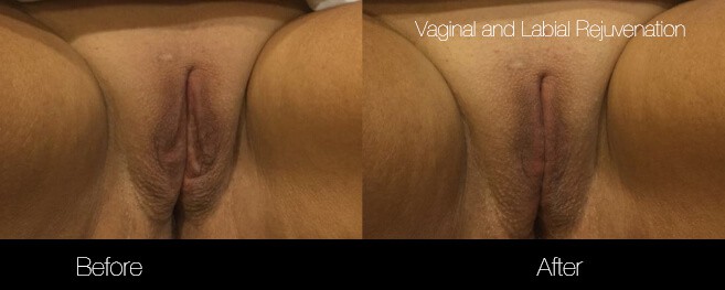 Vaginal Rejuvenation - Before and After Gallery – Photo 2