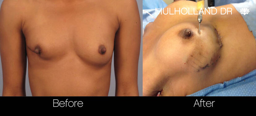 Fat Grafting Breast Augmentation - Before and After Gallery – Photo 31