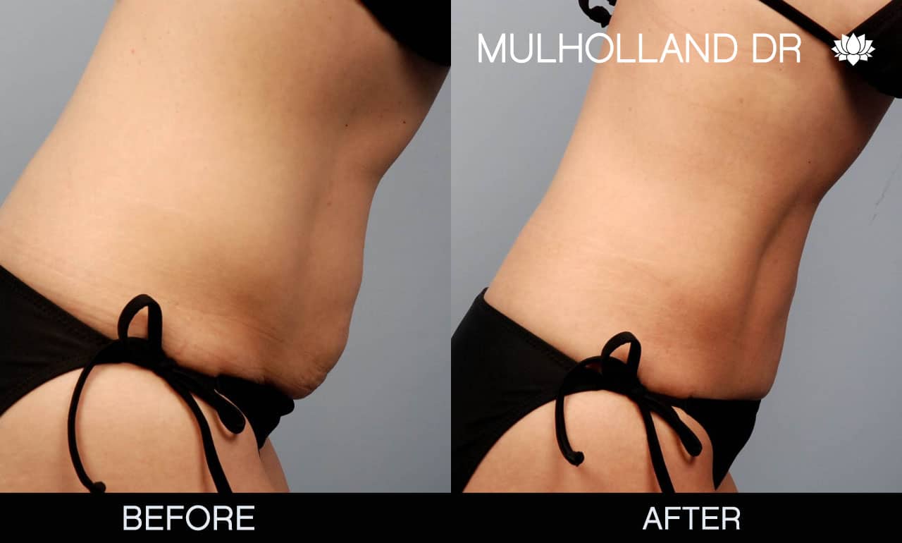 Mini Tummy Tuck - Before and After Gallery – Photo 3