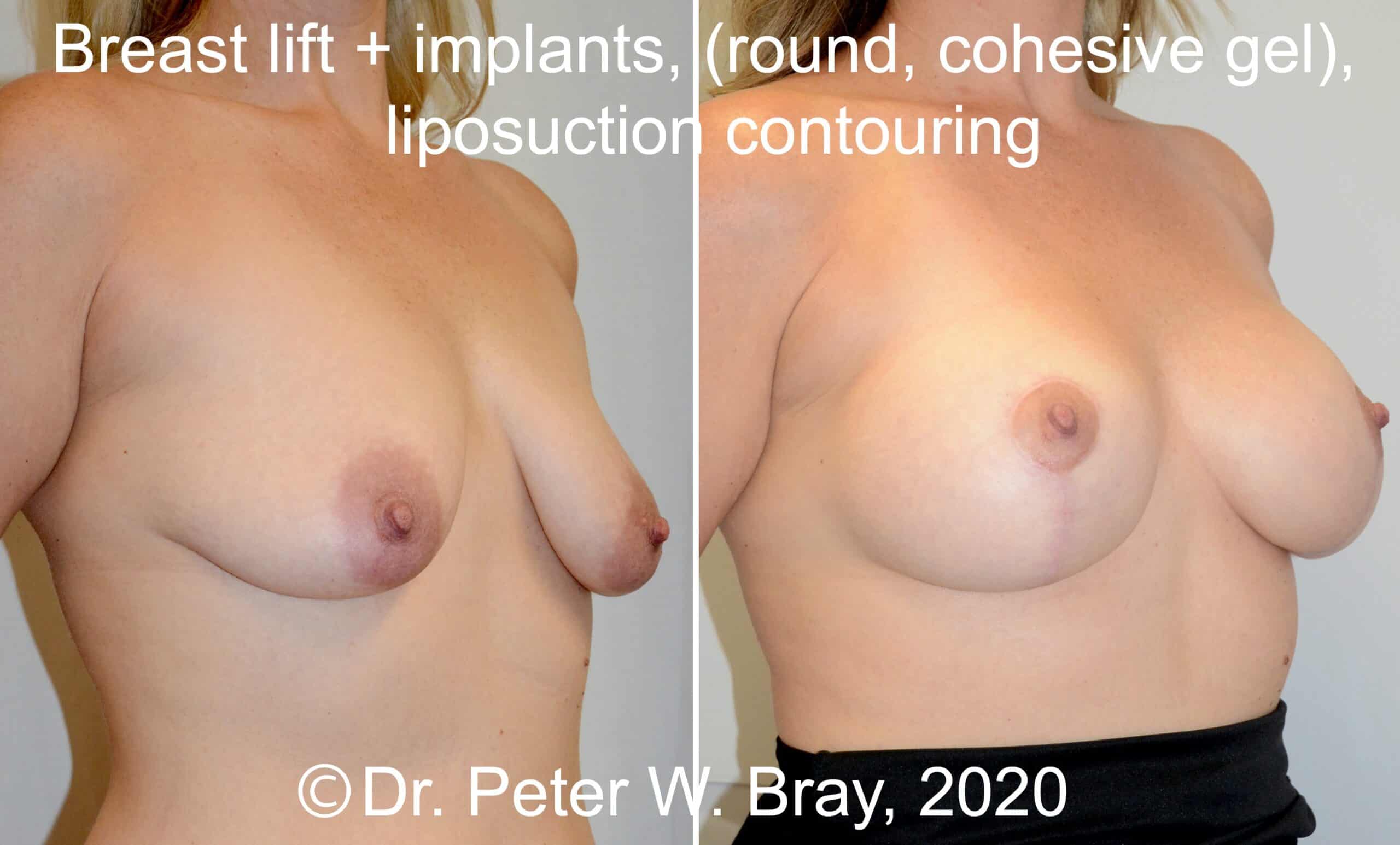 Breast Lift - Before and After Gallery – Photo 3