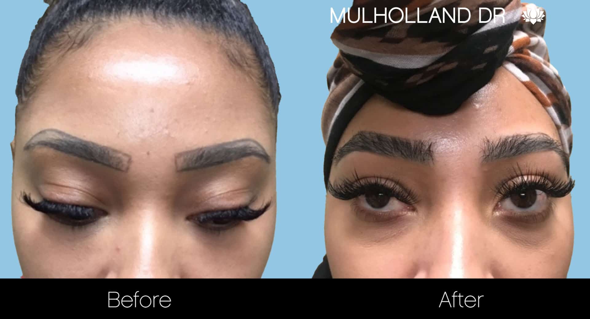 Eyebrows FUE - Before and After Gallery – Photo 3